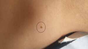 הסרת נגעי עור "Skin Tags" באזור הצוואר