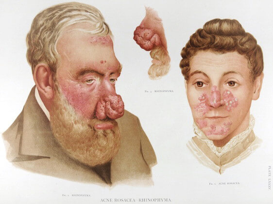 רינופימה ורוזציאה – על תסמונת האף הבולבוסי